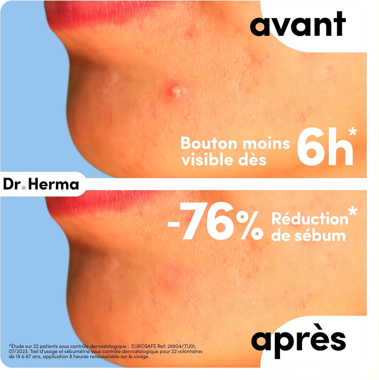 Dr. Herma - Anti-pimple patch, Acne Patch Invisible - Results in 6 to 8 hours - Dermatologically tested - Salicylic acid, hydrocolloids, tea tree oil - Box of 24 patches